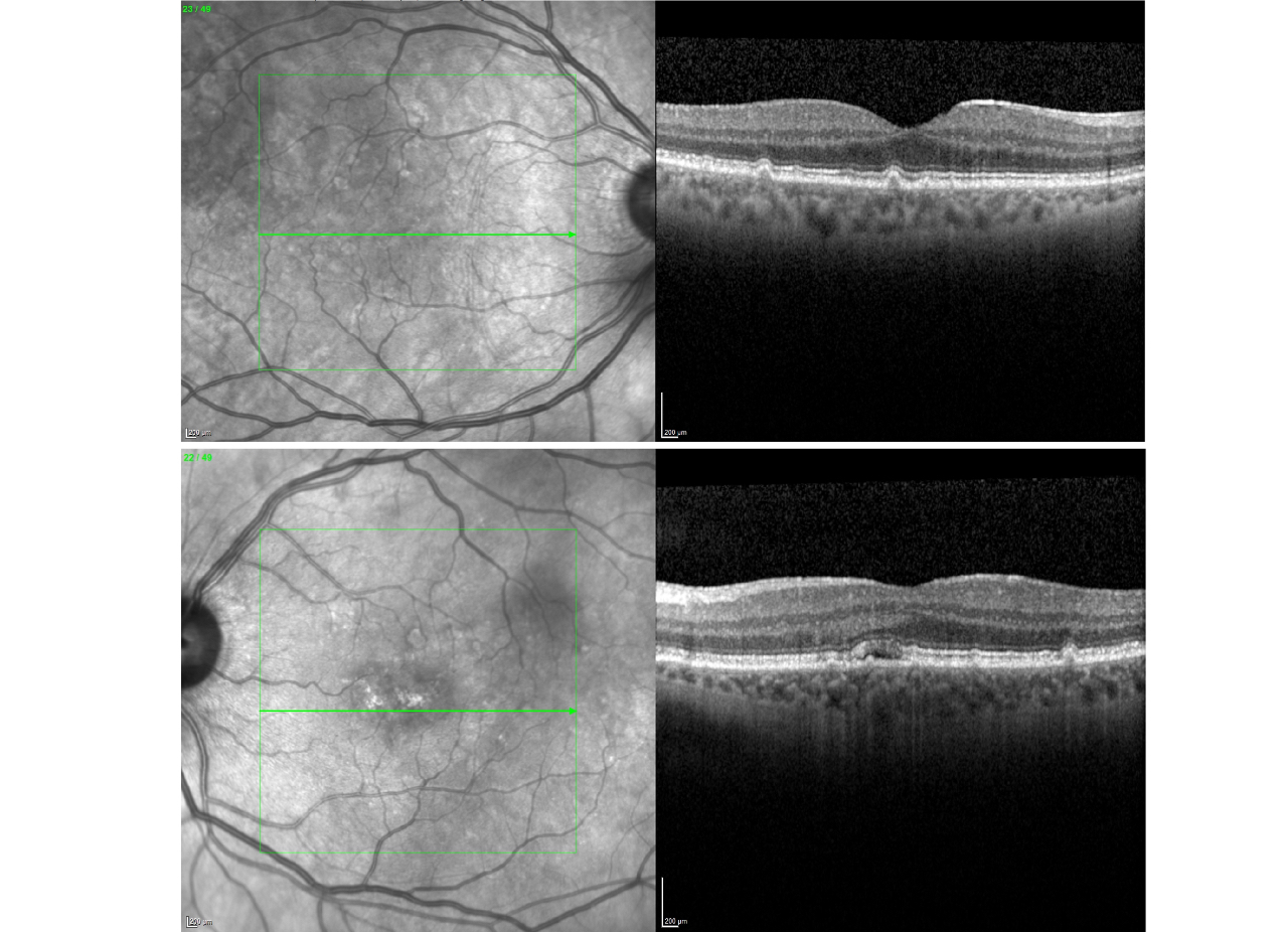 OCT scan of a cross section of a healthy retina and a abnormal retina effected by macula degeneration as captured using the heidelberg spectralis device