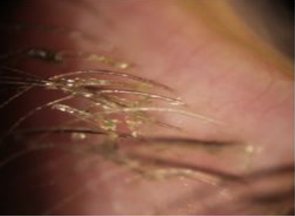 Eyelash debris present due to blepharitis prior to being cleaned at Dean Samarkovski Optometrist