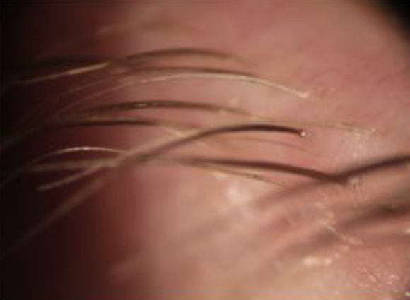 clean lashes following blephex treatment at Dean Samarkovski Optometrist
