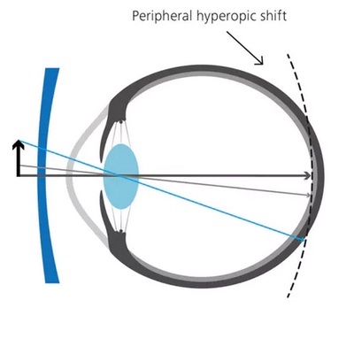 Ray tracing schematic of the human eye showing the optical properties of a standard corrective myopia lens in front of the eye