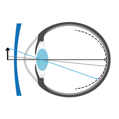 Schematic of the human eye with a ray tracing diagram depicting the optical properties of the MyoVision Pro lens designed for myopia control