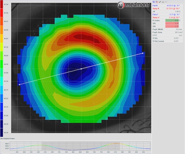 Topography map captured with the Medmont E300 device showing the changes in the corneal profile following 1 month of contact lens wear