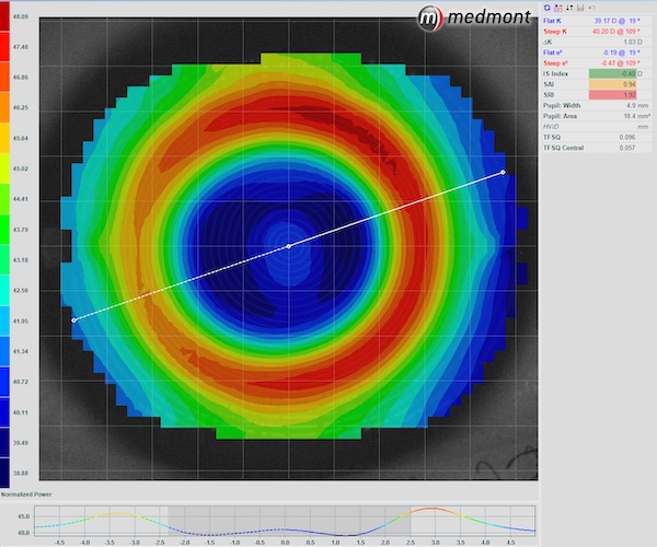 Corneal topography scan showing the profile of a cornea that has been treated with Orthokeratology lenses for 3 for three months