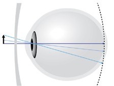 Ray trace diagram of human eye and a standard myopia spectacle lens