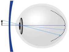 ray trace diagram of human eye and a Zeiss MyoVision Pro lens for myopia prevention
